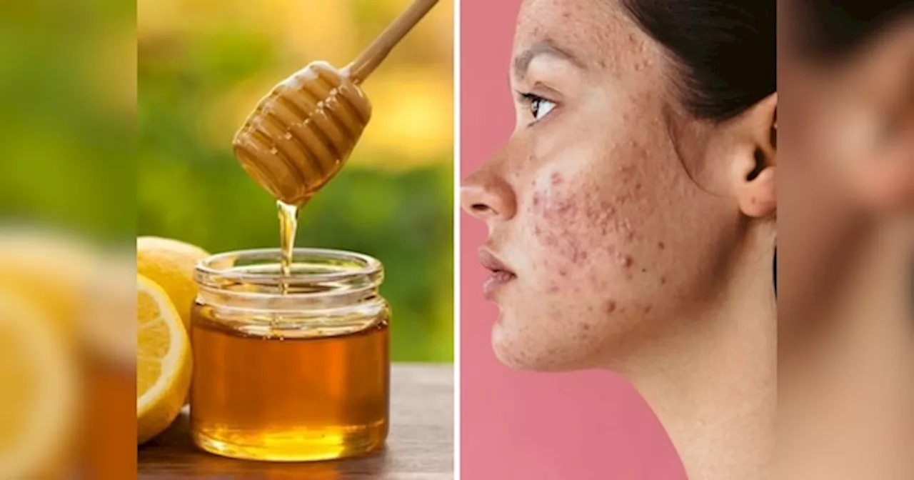 Acne Home Remedies: शहद के साथ इस पीले फल को मिलाकर चेहरे पर लगाएं, हमेशा के लिए मुंहासों से मिल जाएगा छुटकारा!