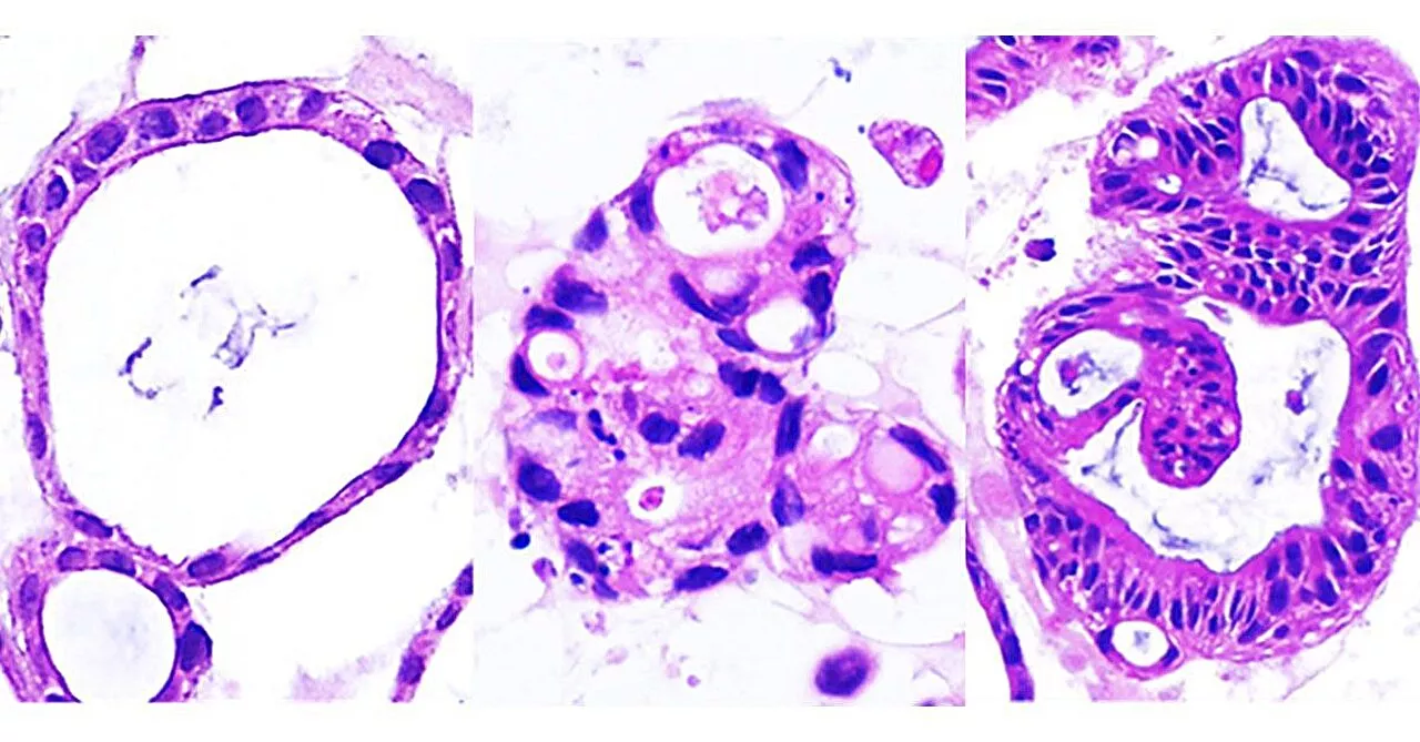 Organoids derived from gut stem cells reveal two distinct molecular subtypes of Crohn's disease