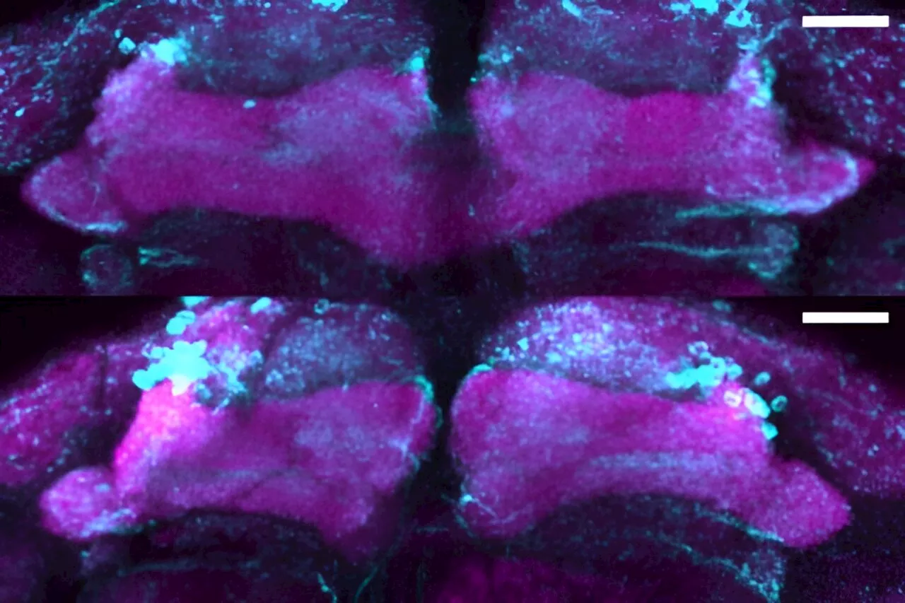 Scientists discover mutation linked to early-onset Parkinsonism