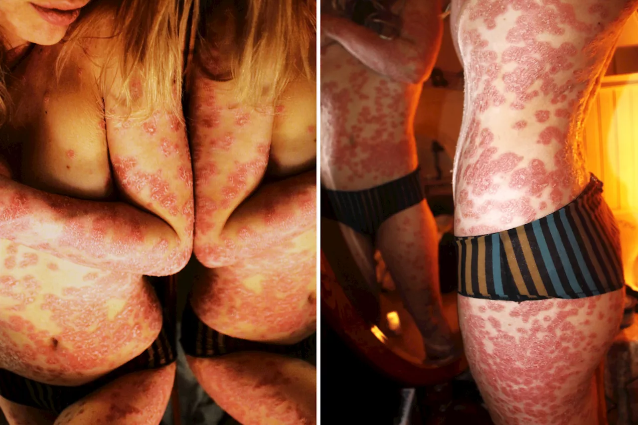 I Developed Psoriasis at 13 After a Heartbreaking Tragedy