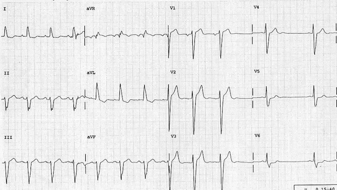 ECG Challenge: Irregular Pulse in a Hypertensive Patient