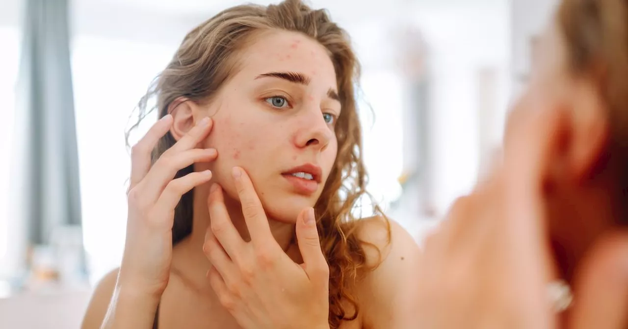 Clear spots and acne by adding one common vitamin to your routine