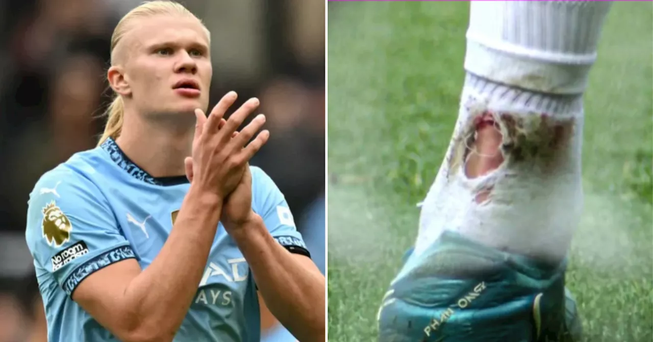 Pep Guardiola provides Erling Haaland injury update