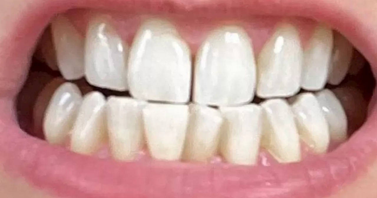 Teeth whitening kit that doesn't harm your gnashes now on sale for under £20