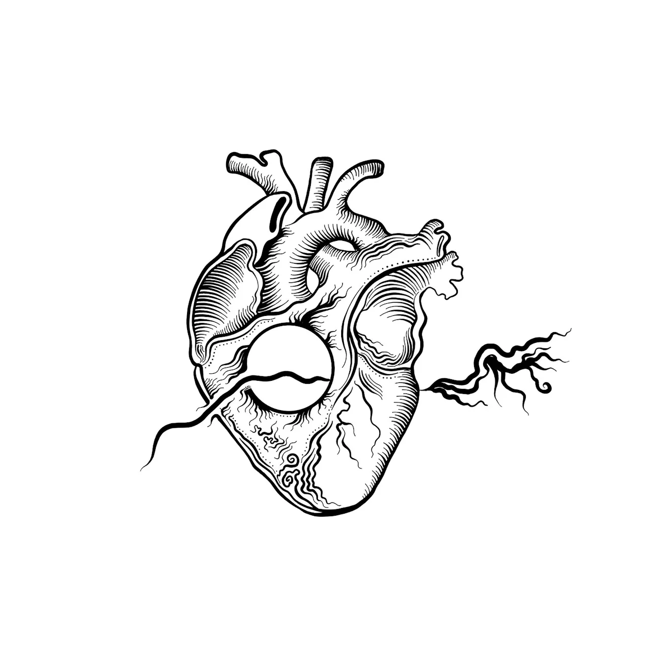 Transcatheter edge-to-edge repair found non-inferior to surgery in patients with secondary mitral regurgitation