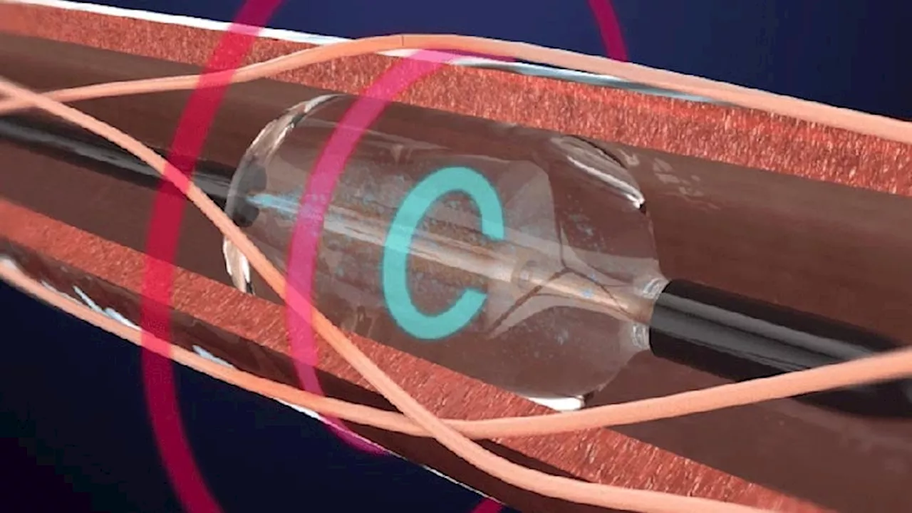 Nighttime and Early Morning BP Controlled by Renal Denervation