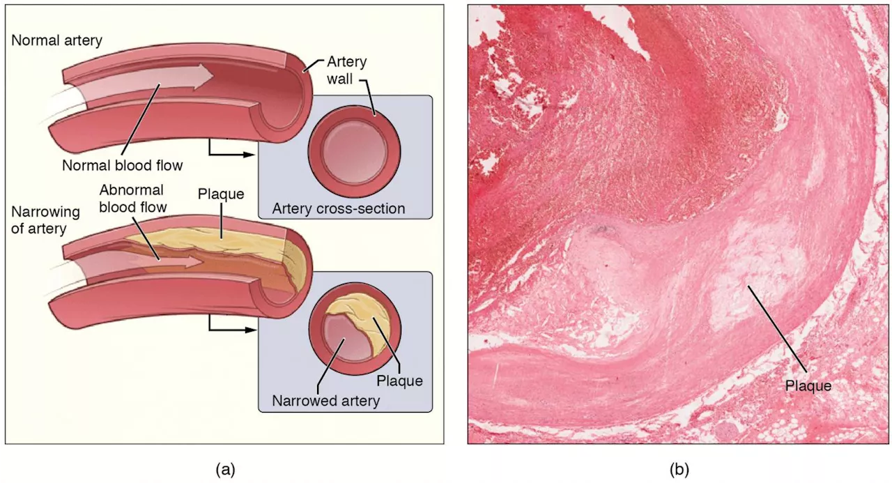 High cholesterol levels at a young age found to be a significant risk factor for atherosclerosis