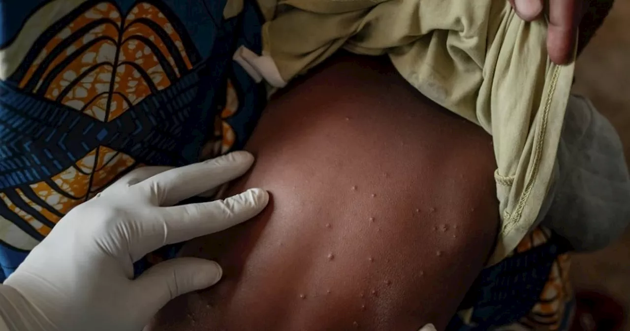 SA’s HIV burden a concern as new mpox strain spreads in DRC