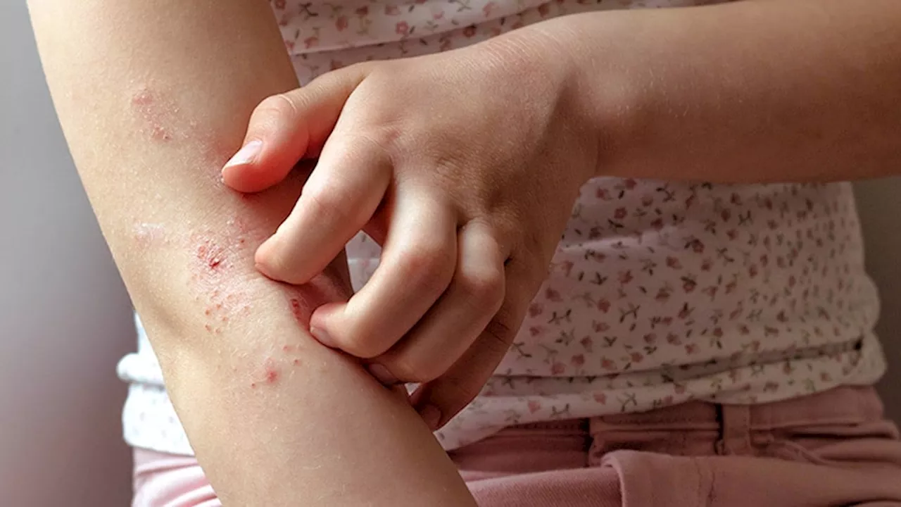 BMI in Childhood Linked to Risk for Skin Diseases