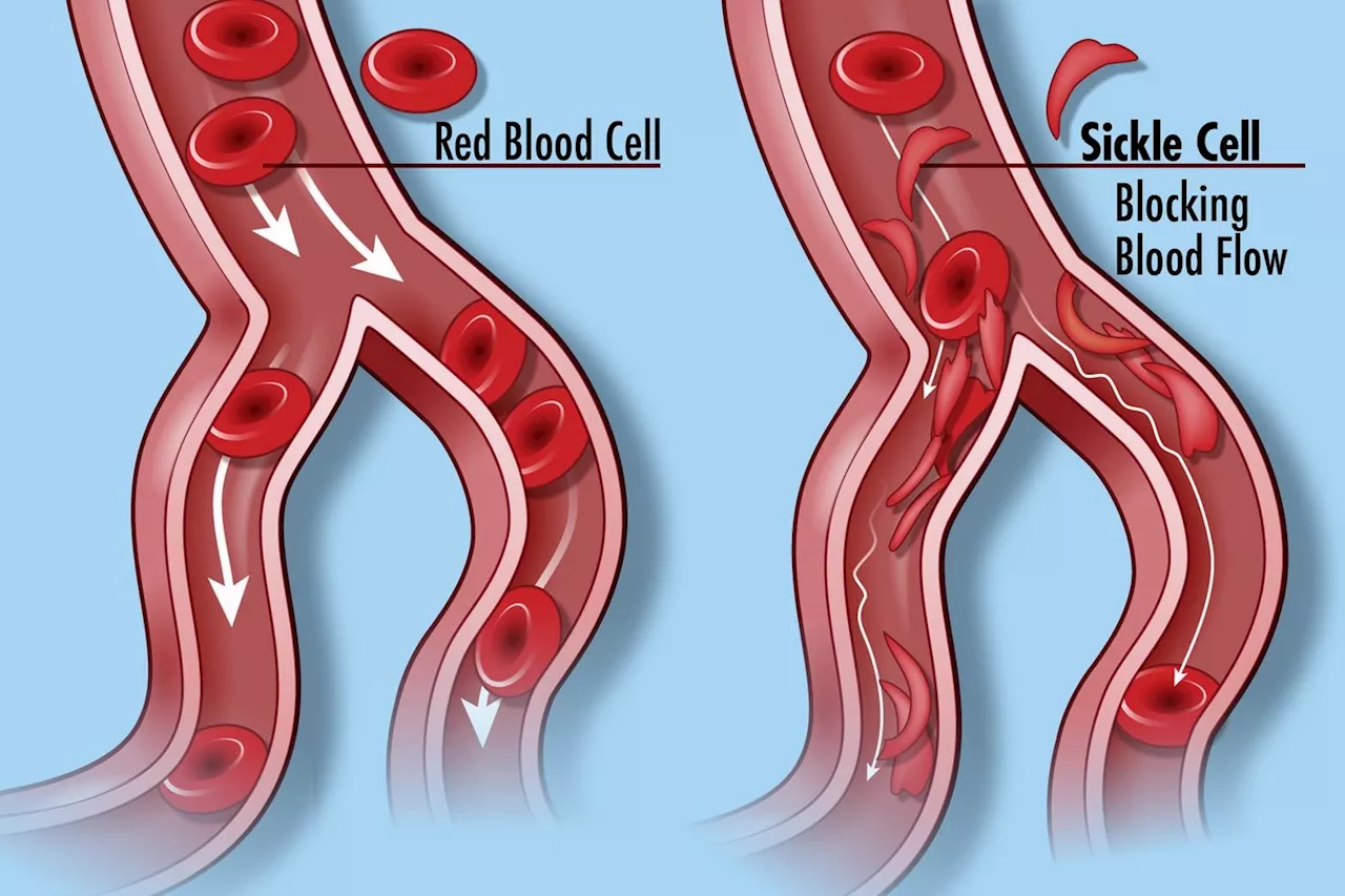 Shining a light on Sickle Cell Disease Awareness Month