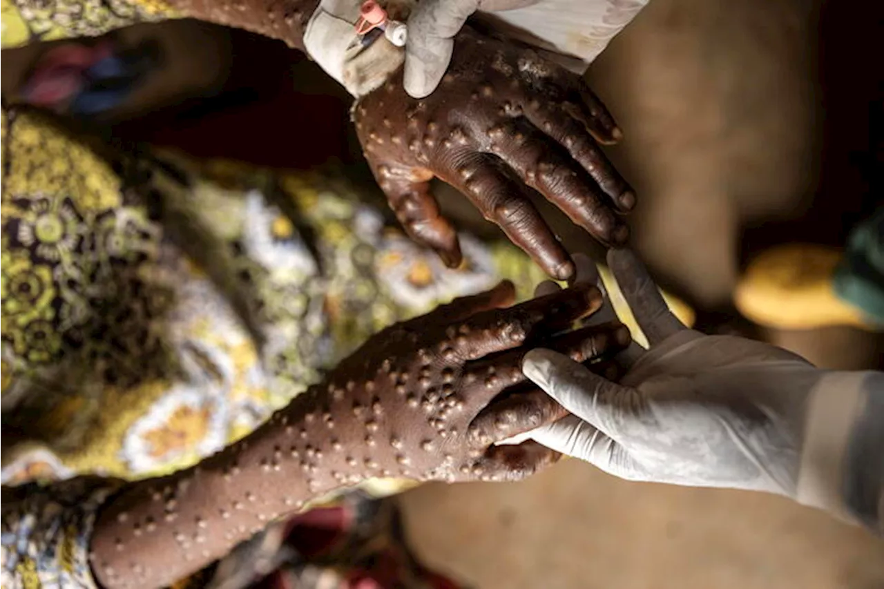 Mpox, in Congo le prime 100mila dosi di vaccino fornite dall'Ue