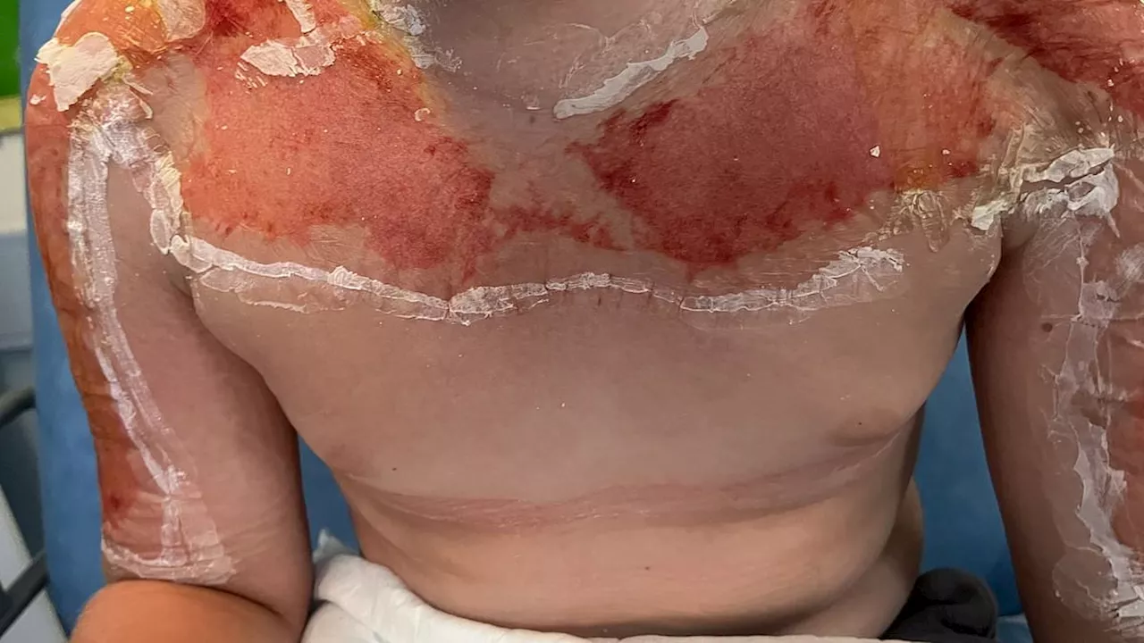 Horrifying images show danger of buying sun cream abroad - as 10 year-old is hospitalised with...