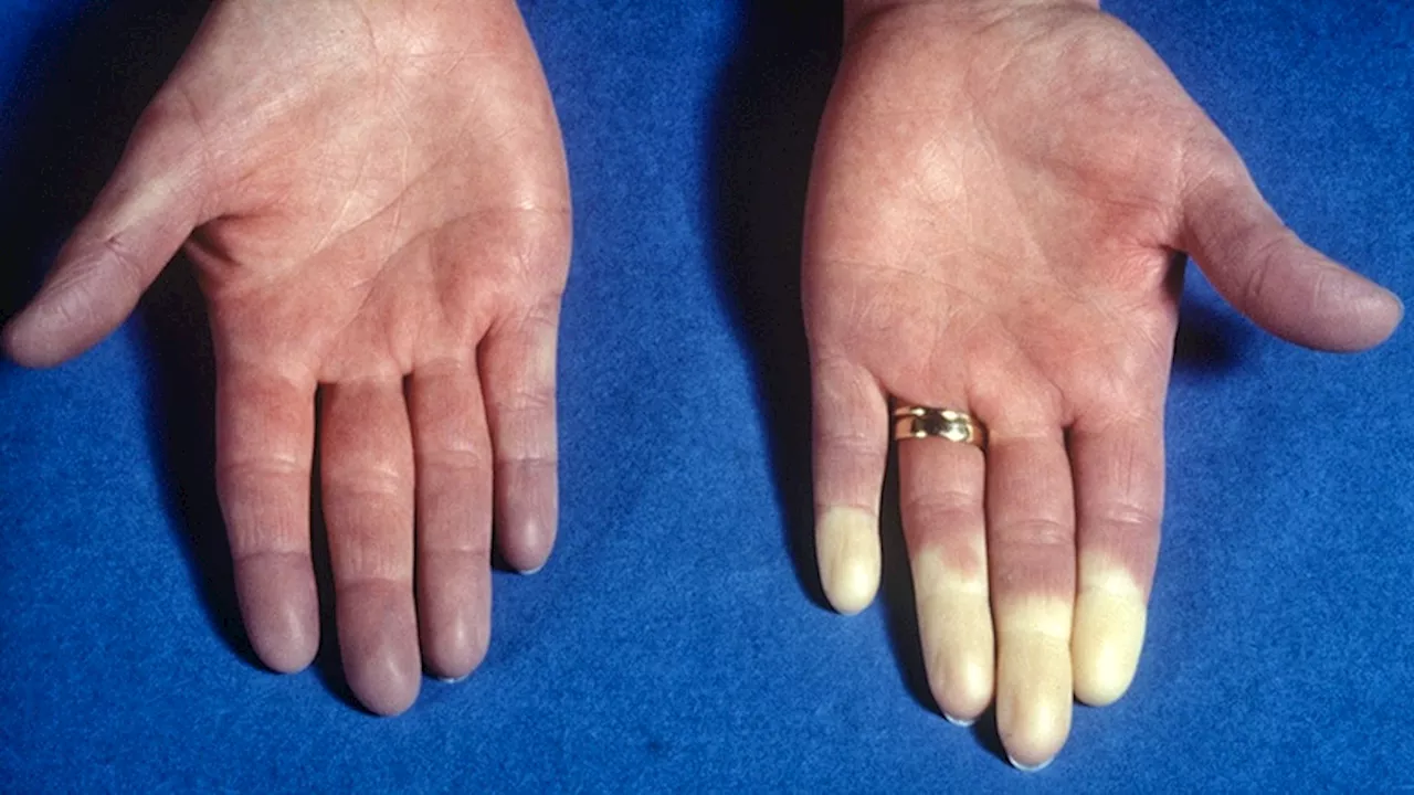 High Temperatures Also Exacerbate Raynaud, Study Suggests