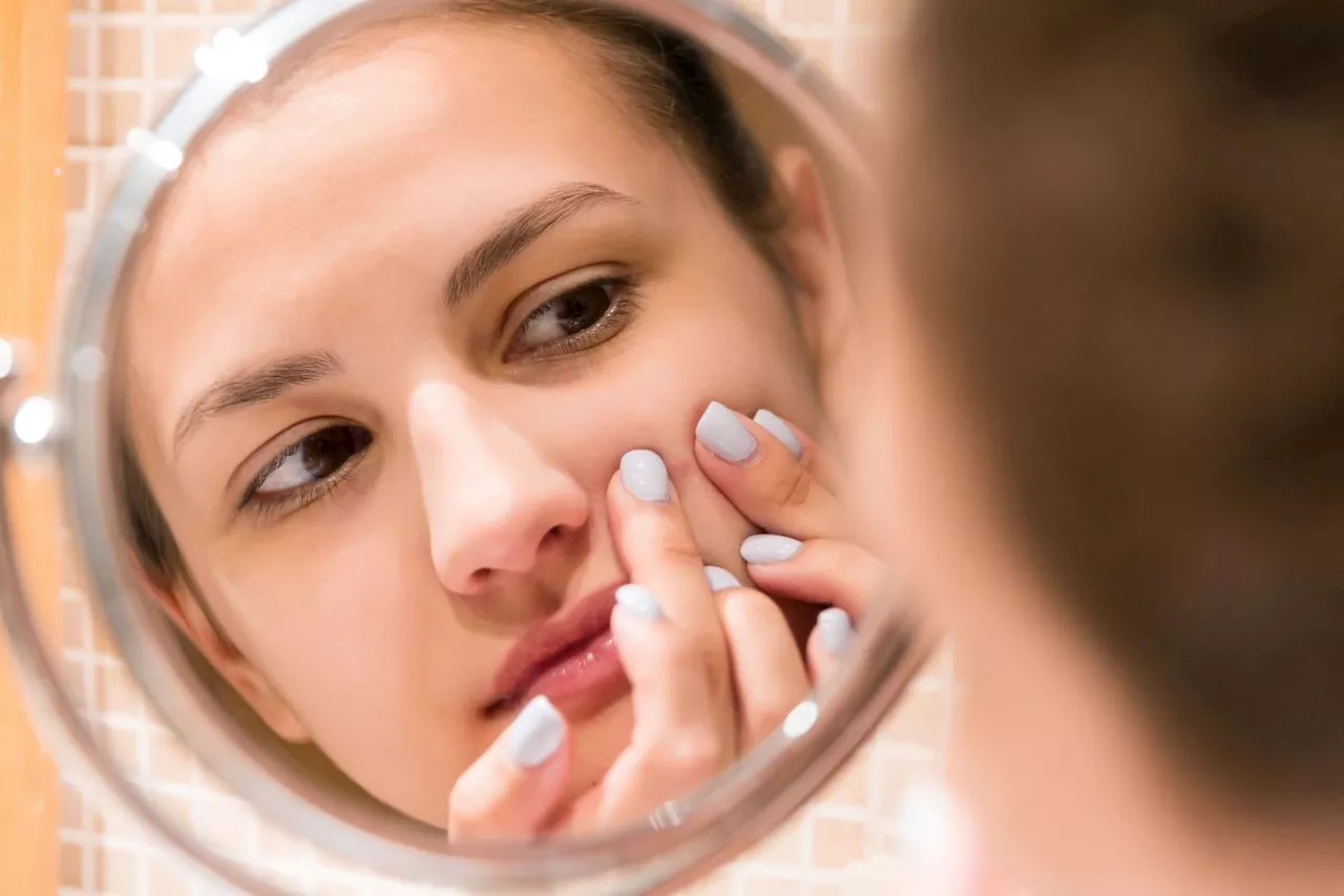 3 main causes of teen acne every parent needs to know (and how to manage it)