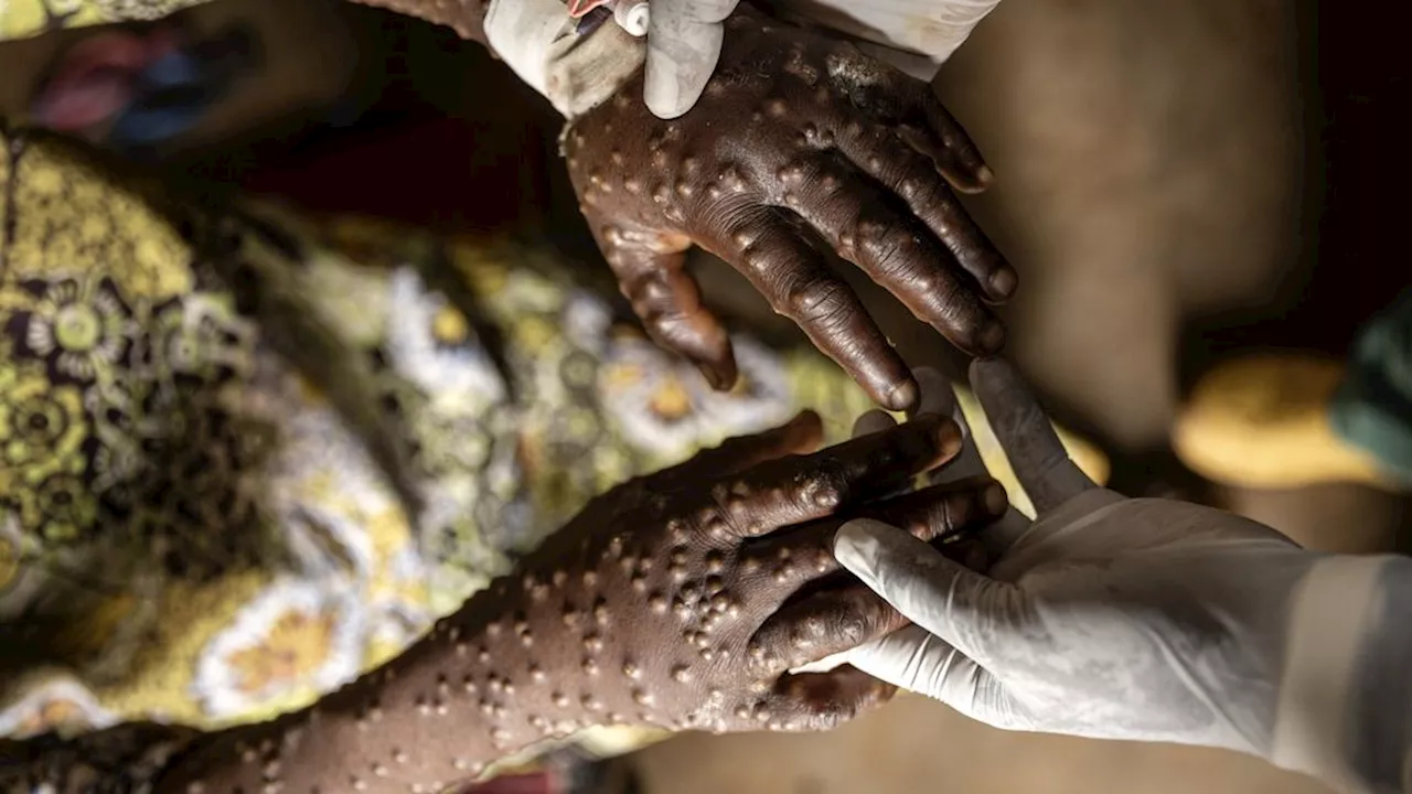 Mpox grijpt sneller om zich heen, Afrika komt met plan voor hele continent