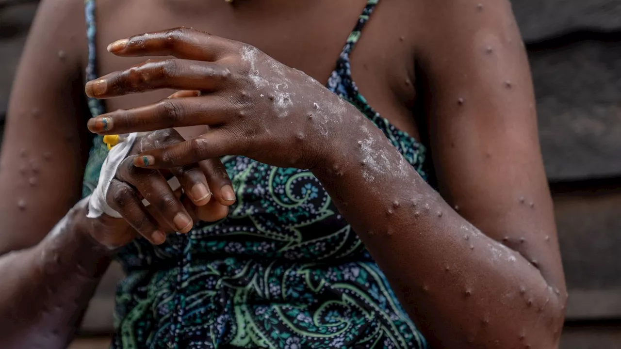 Mpox : la propagation du Mpox en Afrique centrale s’accélère