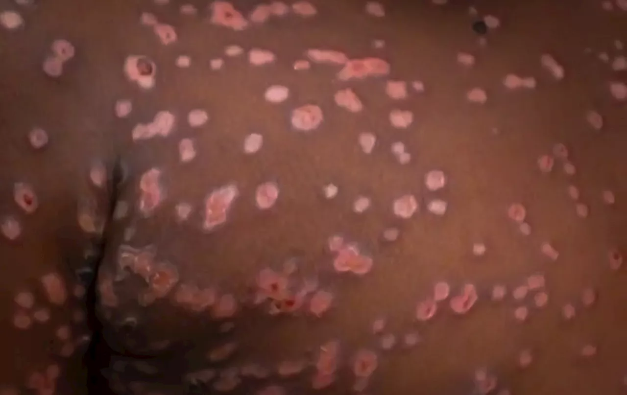 Akwa Ibom records five mpox cases as contact tracing begins