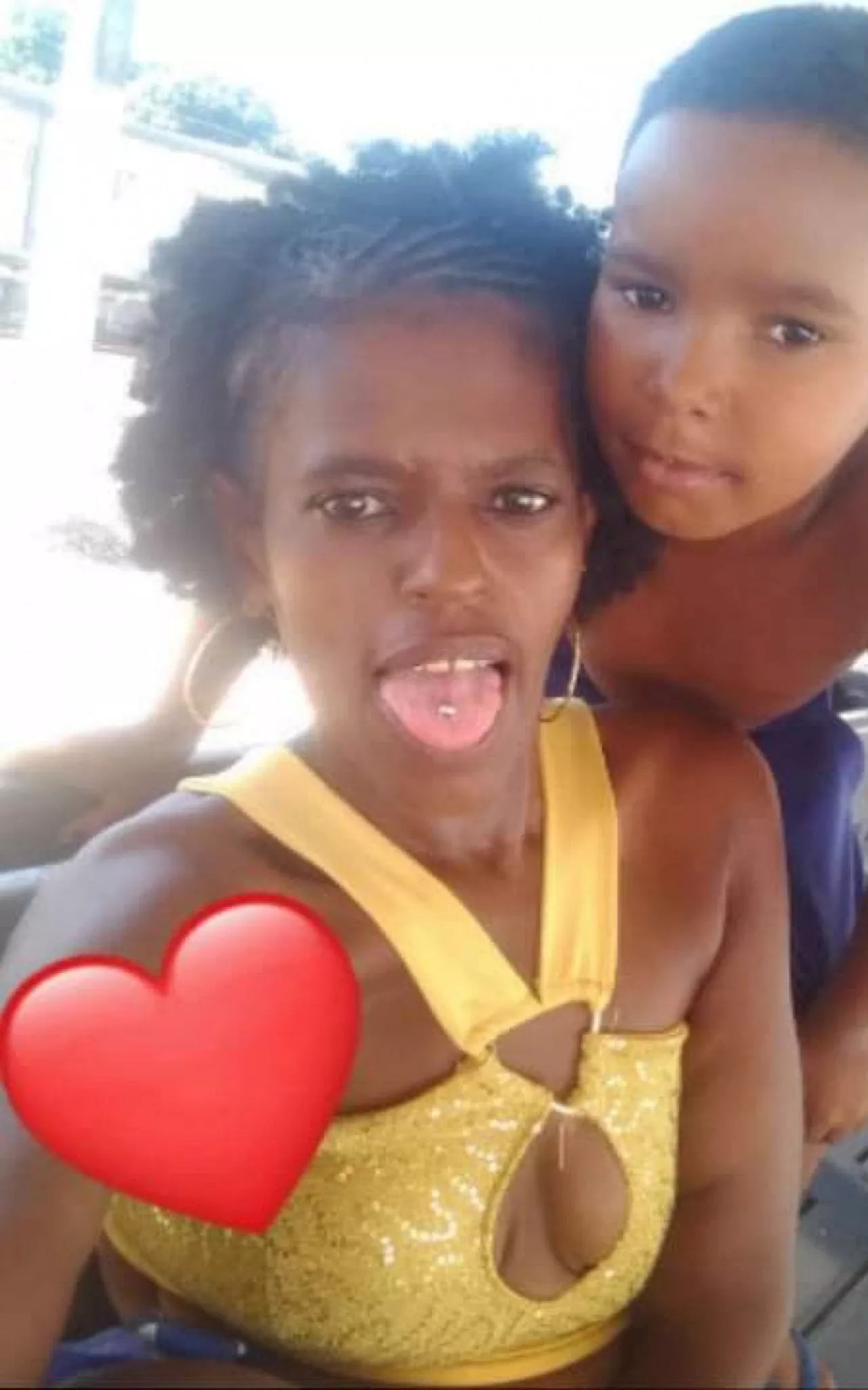 Menino que teve braço amputado em acidente apresenta melhoras após cirurgia de reimplante