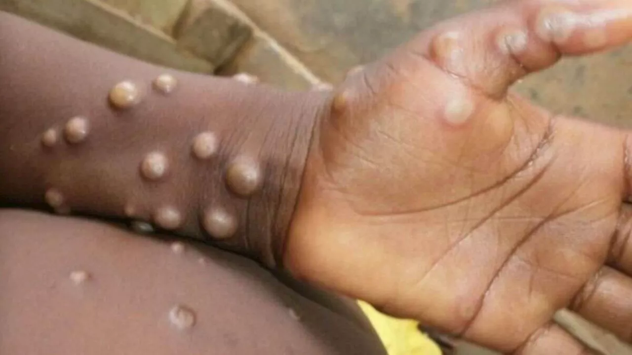 Mpox Virus: एमपॉक्स ने सरकार की बढ़ाई चिंता, केंद्र ने सभी राज्यों को जारी की एडवाइजरी; दिल्ली में मिला पहला संदिग्ध