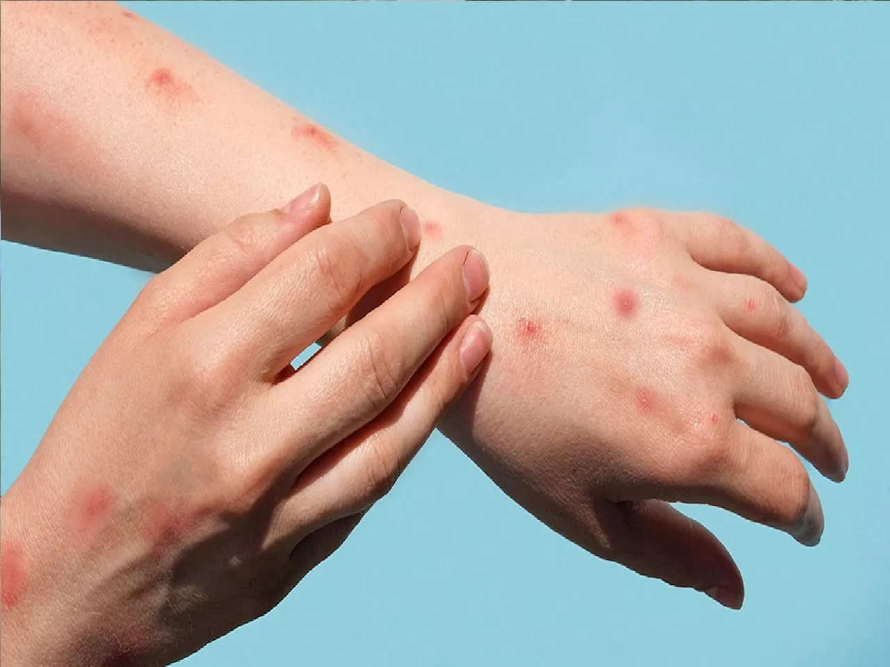 भारतात Monkeypox चा धोका आहे का? केंद्र सरकारने स्पष्टच सांगितलं