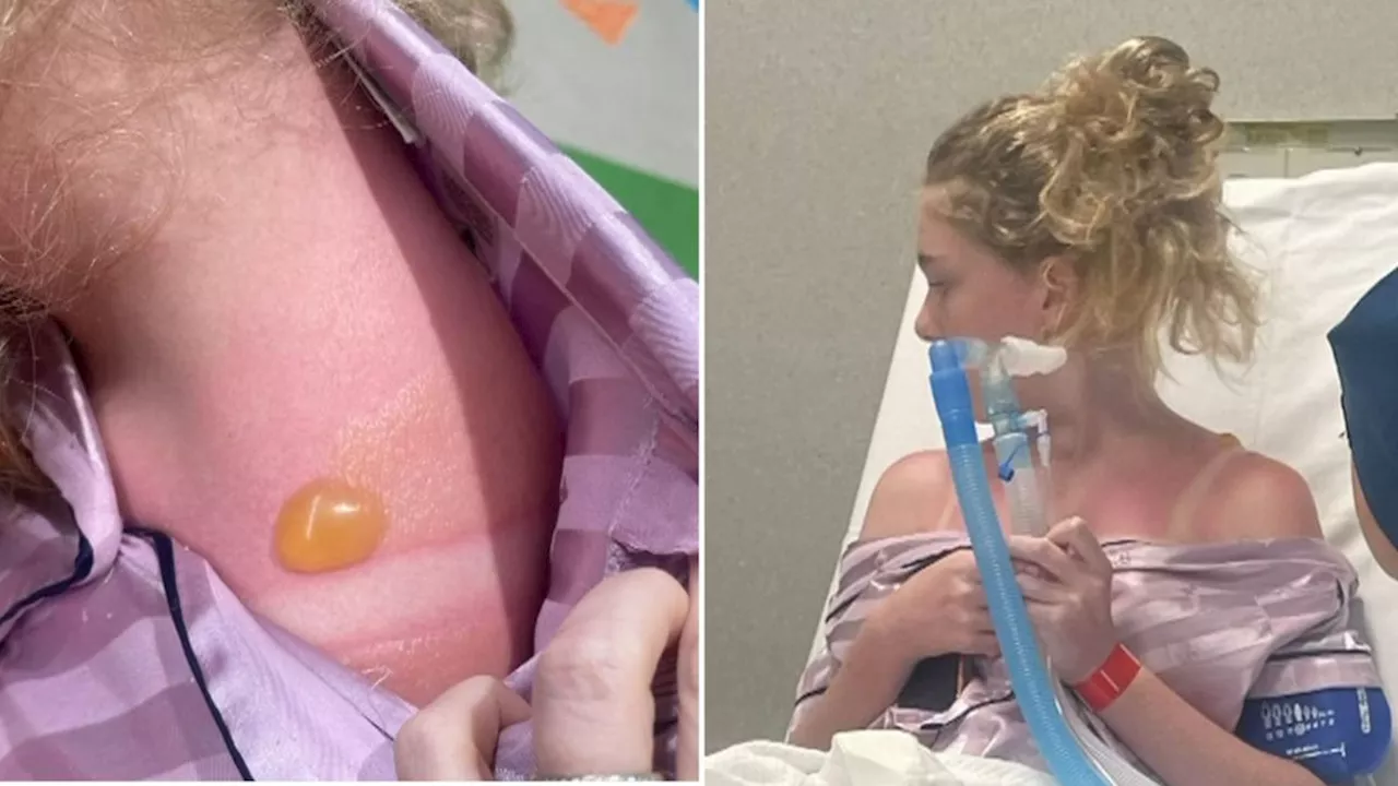 Perth girl’s sunburn lands her in hospital as health expert warns of surging cases