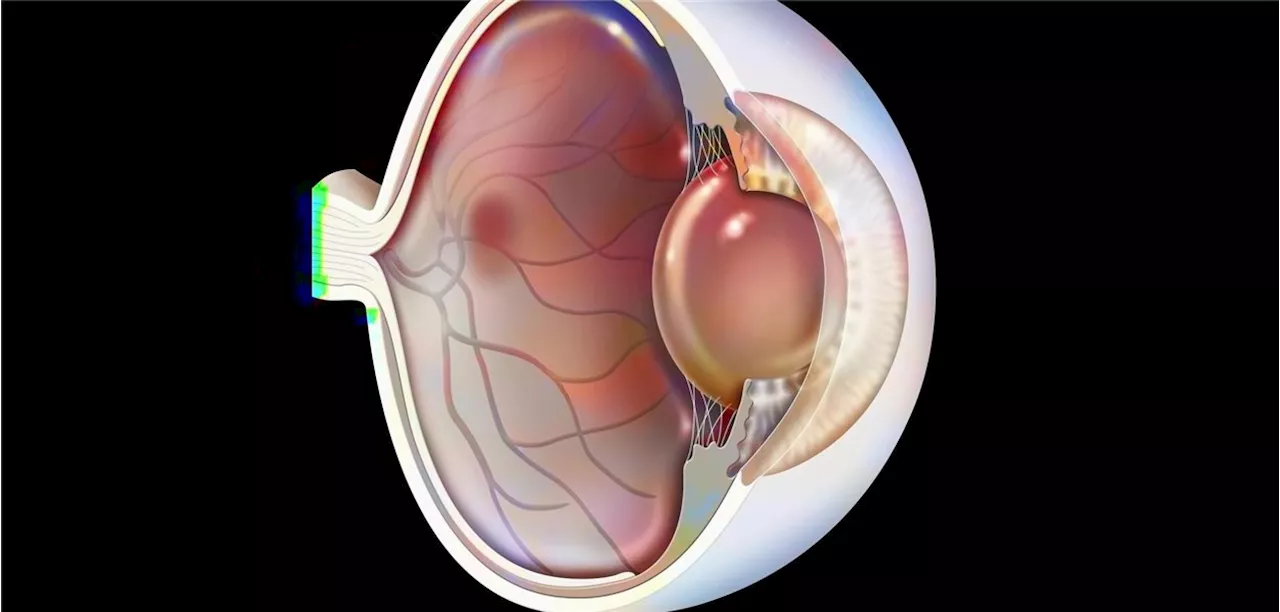 Randomisierte Studie an 30 Zentren : Feuchte Makuladegeneration: Stereotaktische Radiotherapie könnte einige Injektionen ins Auge ersparen