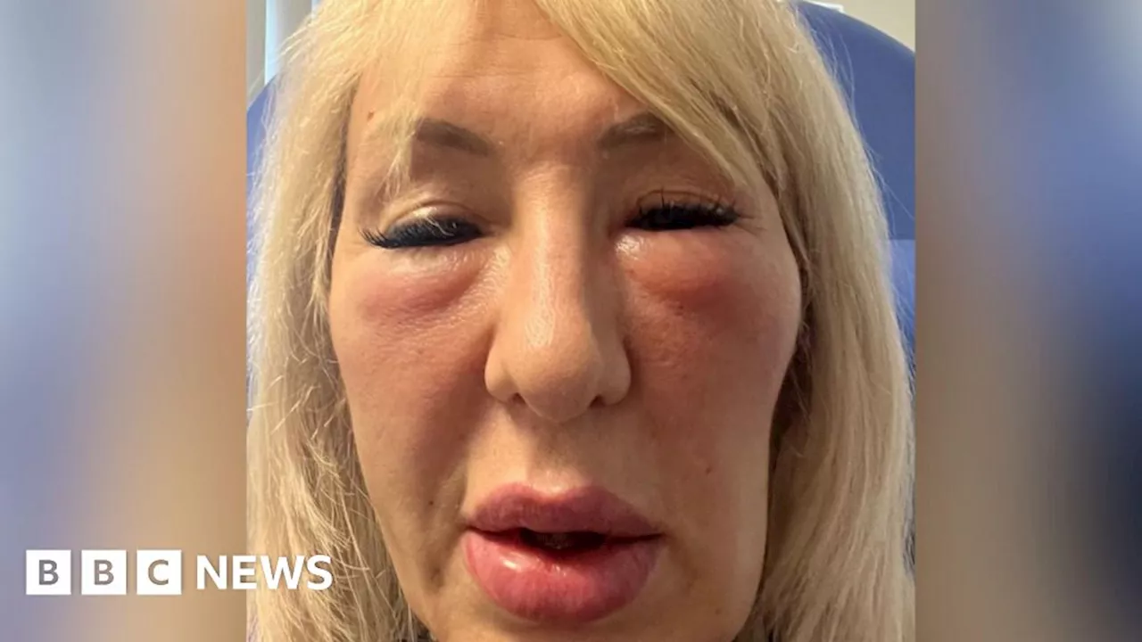 Bogus Doctor Left Woman 'Looking Like a Gargoyle' After Botched Face Fillers