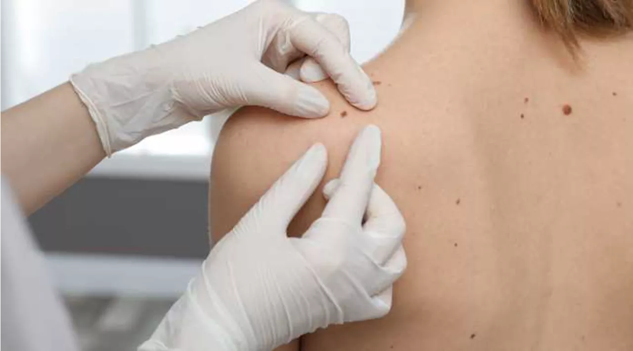 Melanoma: mai così tanti casi, ma la prognosi migliora