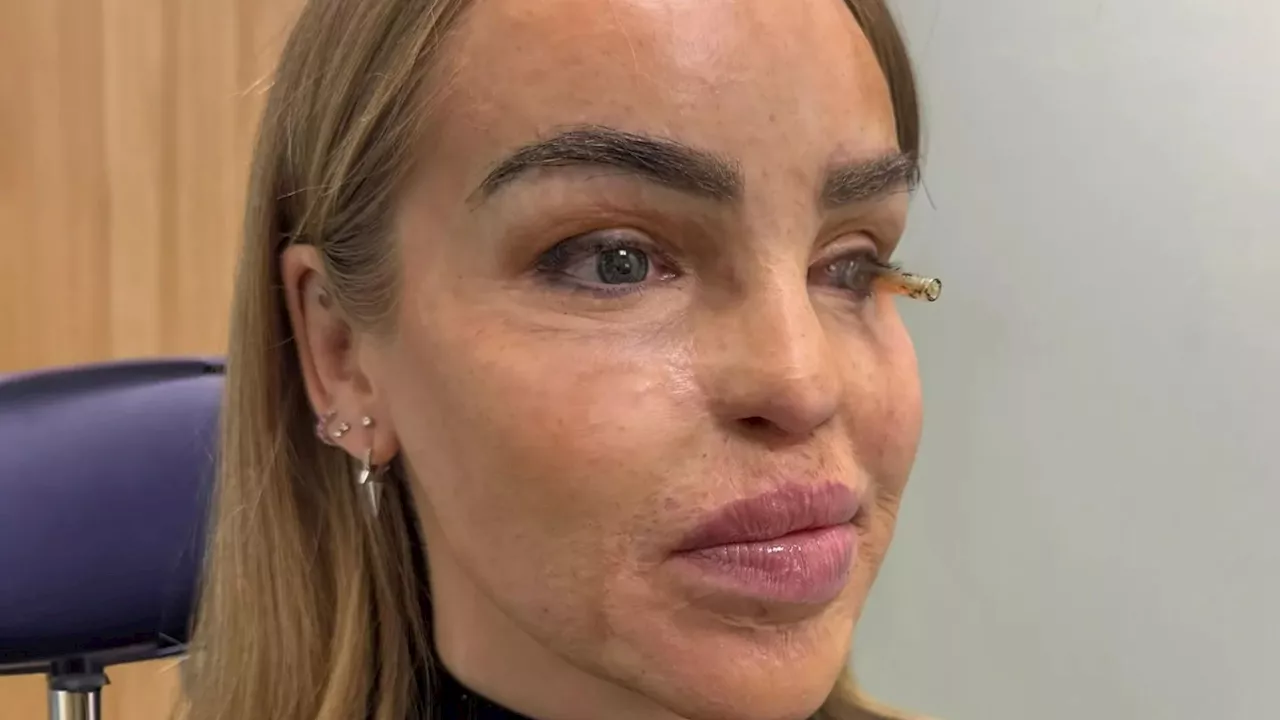 Katie Piper to Receive Prosthetic Eye