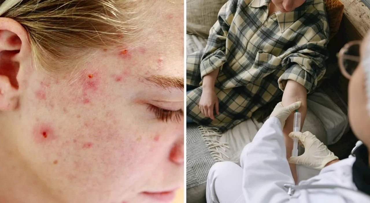 Acne: un Sintomo Raro di Cancro al Cervello