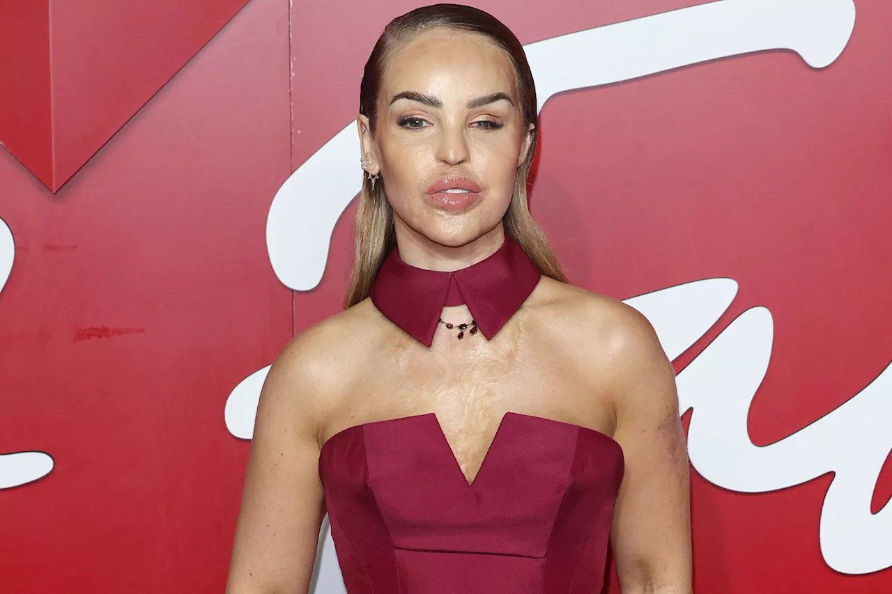 Katie Piper to Get Artificial Eye Nearly 17 Years After Acid Attack