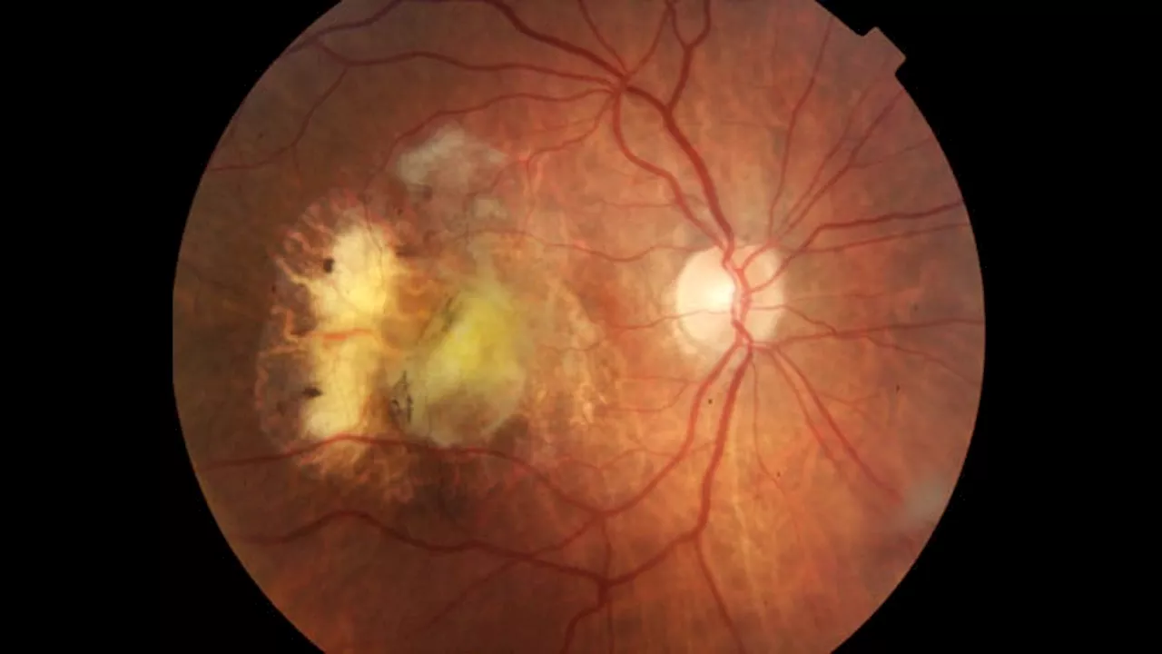 Both High and Low HDL Linked to Age-Related Macular Degeneration Risk