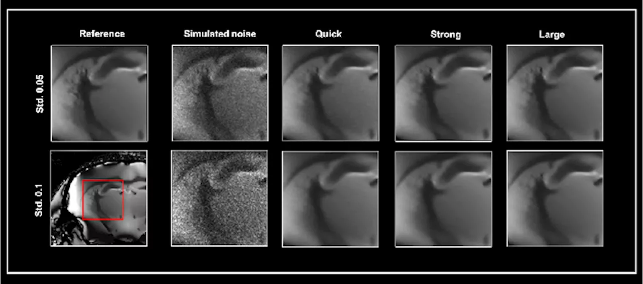 Improving noise reduction methods in structural MRI imaging