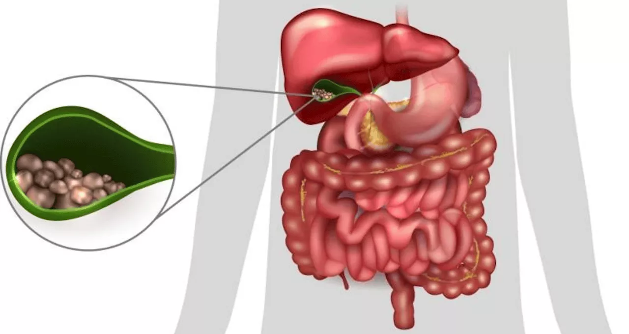 Dolor abdominal continuo, ictericia, orina oscura y otros síntomas que pueden indicar cálculos biliares