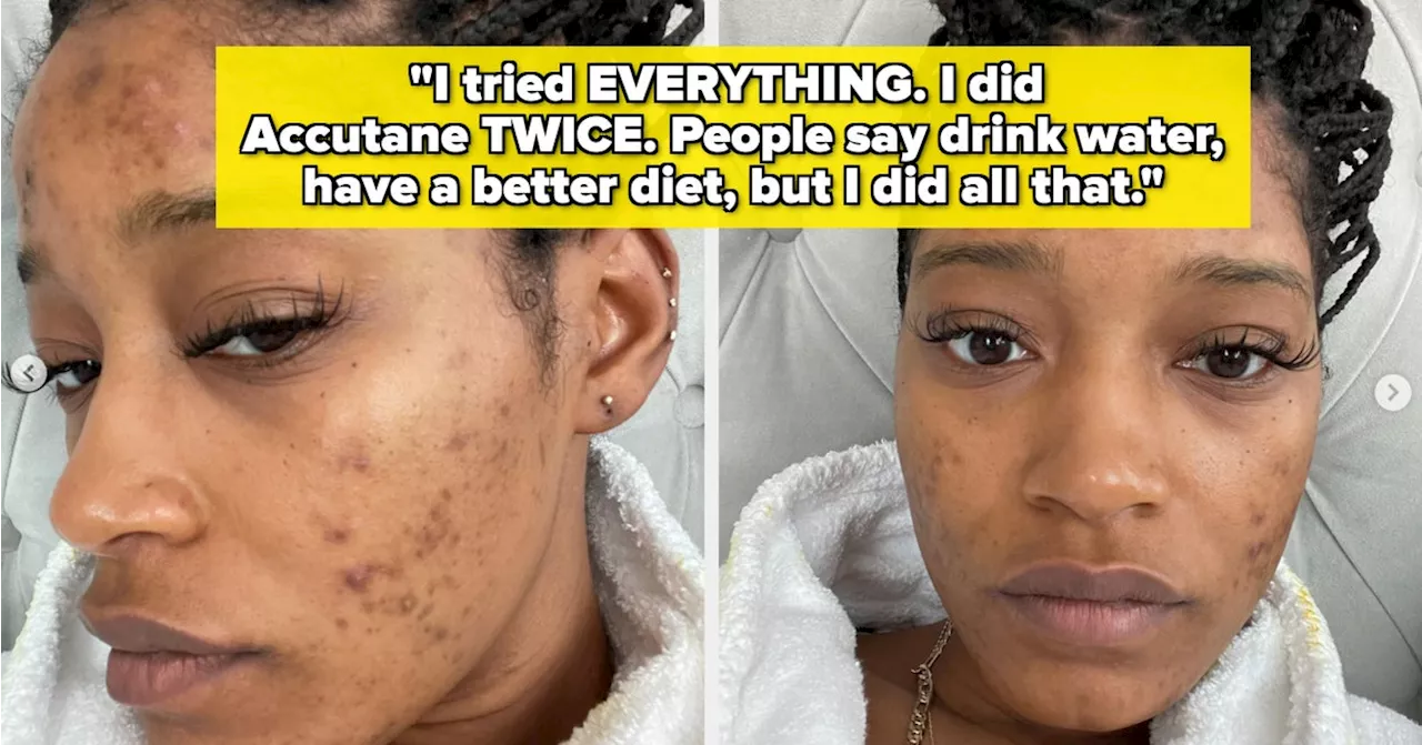 Singer SZA Opens Up About Struggling with Acne