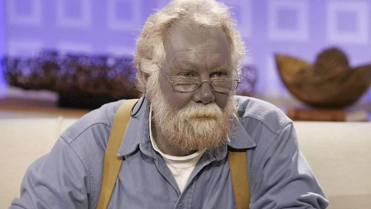 Argyria: The Blue Skin Syndrome