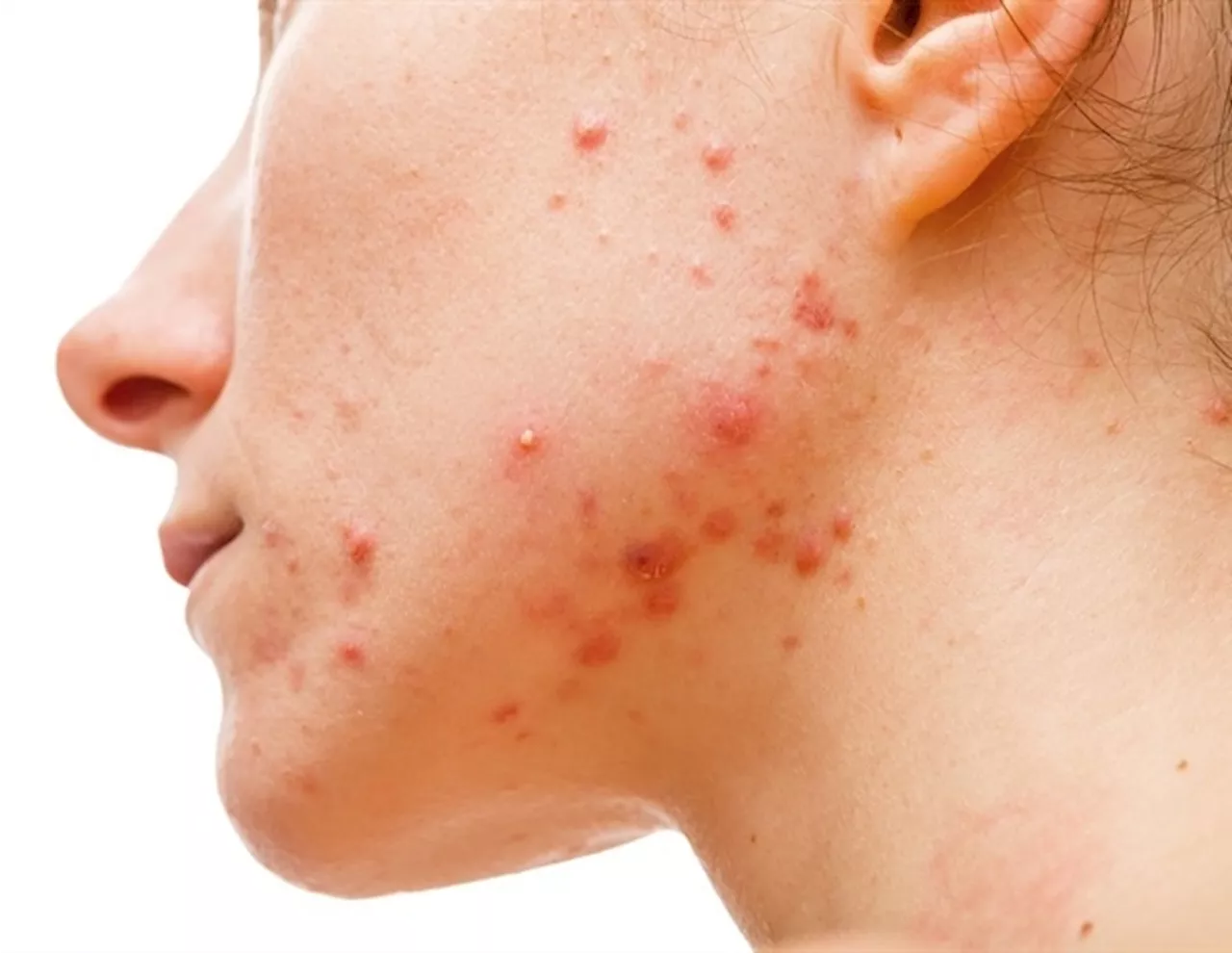 Personalized Dosing Regimens Can Optimize Acne Treatment Outcomes with Isotretinoin