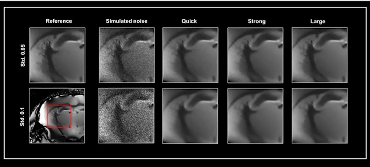 Smart Noise Reduction: Enhancing MRI Image Quality with AI