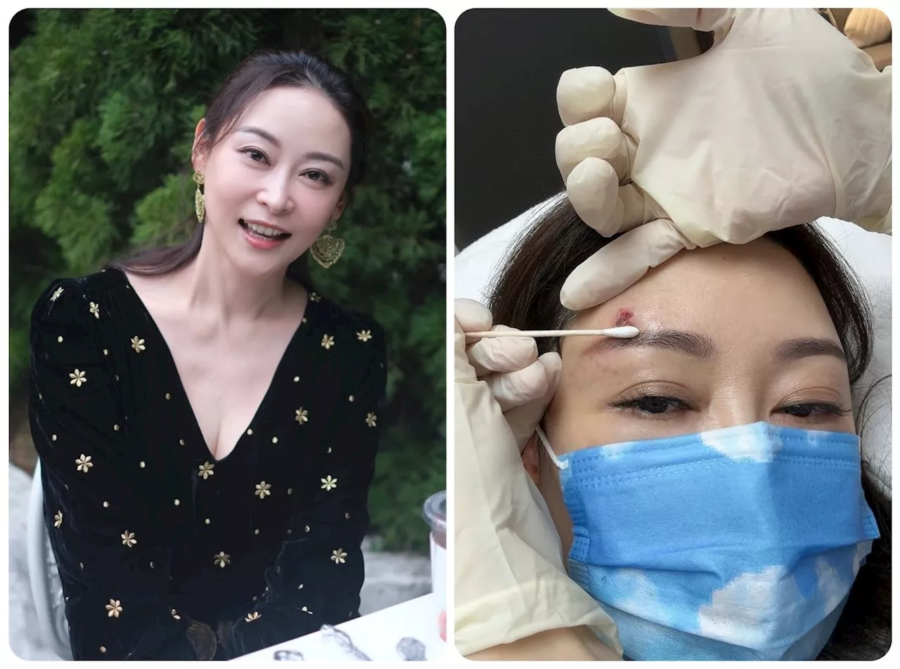 TVB actress Griselda Yeung suffers facial injury from suspected insect bite during filming in China