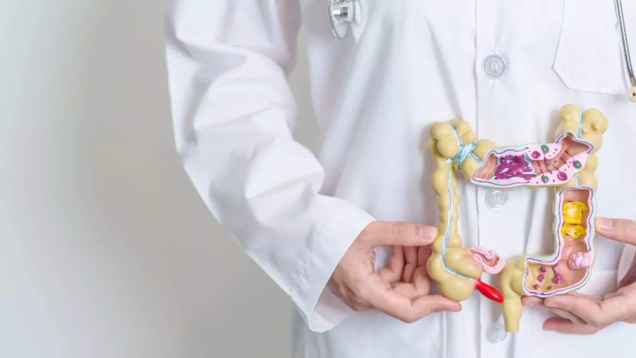 Cinco síntomas del cáncer de colon que a menudo se confunden con otras afecciones: no los ignore