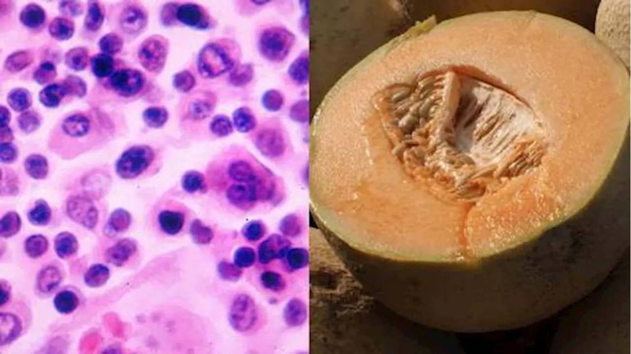 What salmonella symptoms to watch out for as cantaloupe-linked outbreak kills 5 in Canada