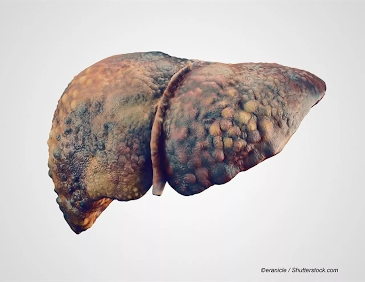 Evaluating biomarkers for diagnosing minimal hepatic encephalopathy in cirrhotic patients