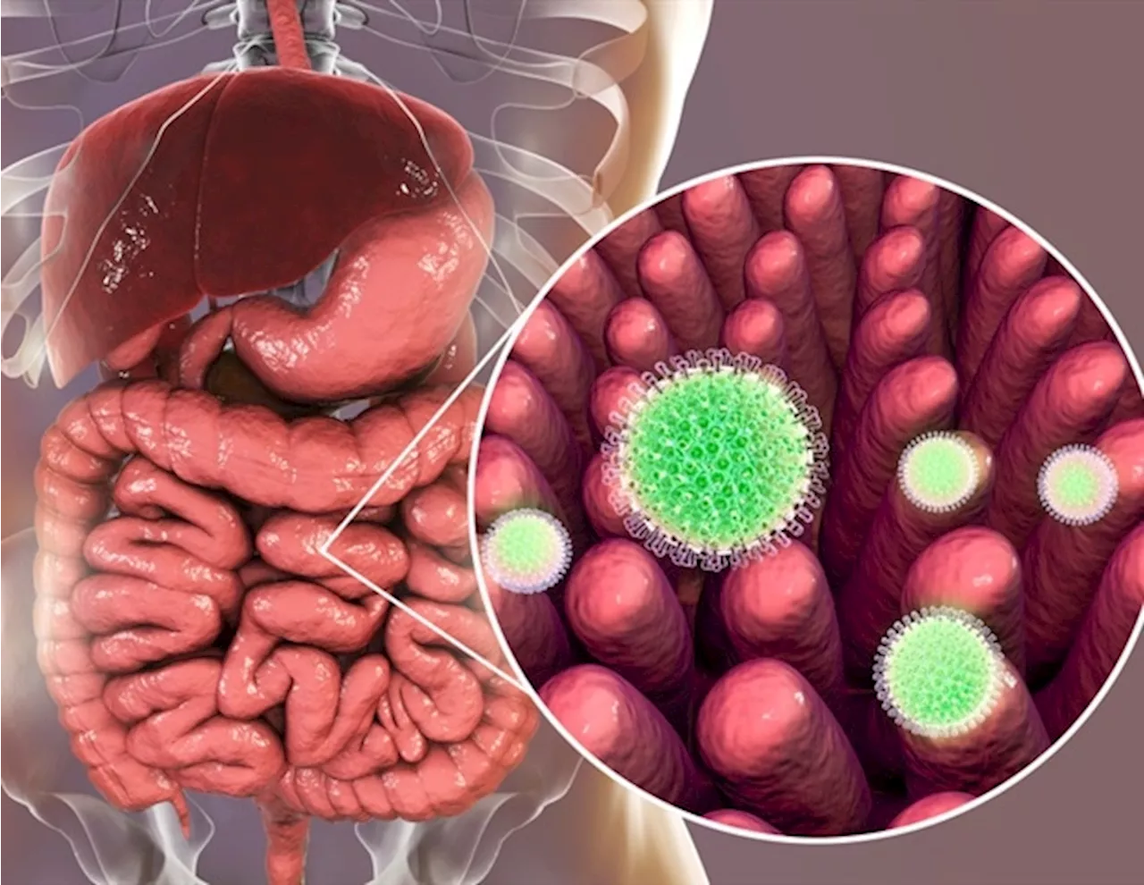 Study uncovers key role of NSP4 in rotavirus disease severity