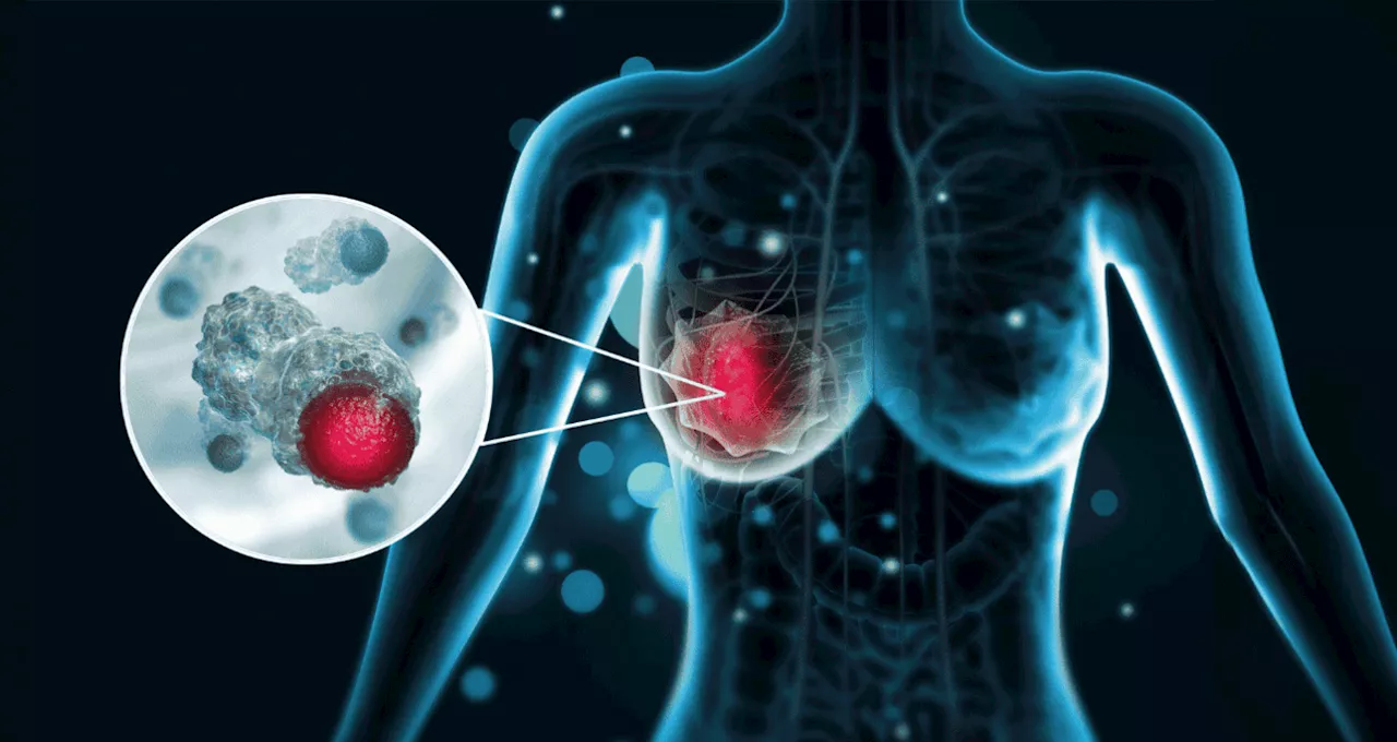 Combinación de giredestrant y palbociclib reduce en un 75% la proliferación celular en cáncer de mama