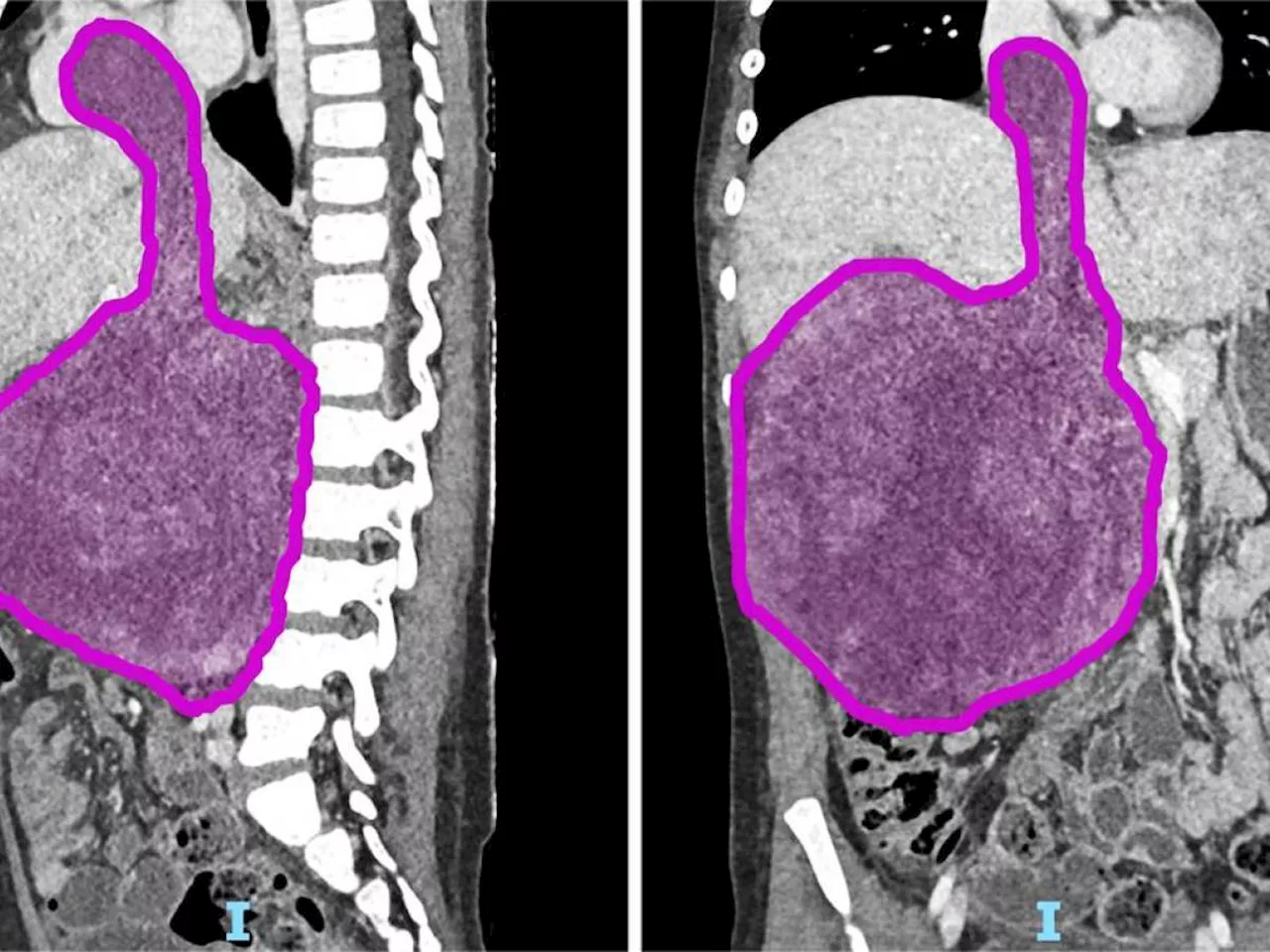 Bambina di otto anni sopravvive a intervento chirurgico straordinario per asportare un nefroblastoma di 1,5 chili