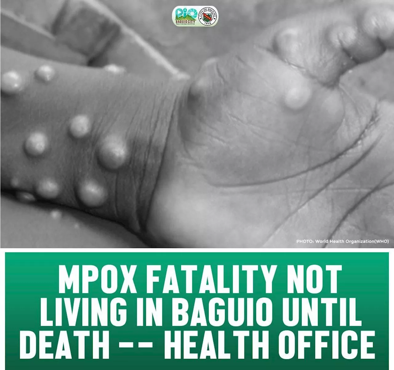 First Mpox fatality in Baguio not a resident