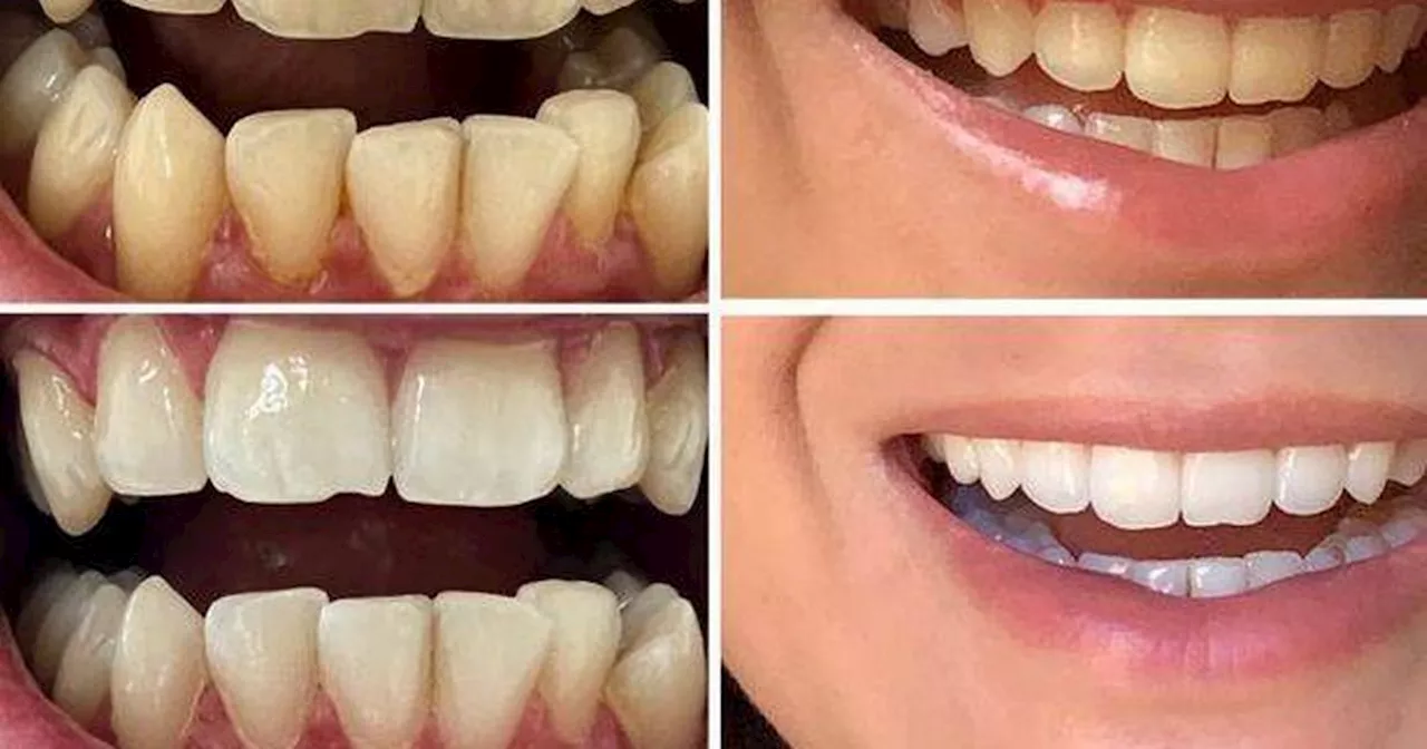 MySweetSmile's January Sale Offers 30% Off Teeth Whitening Bundles