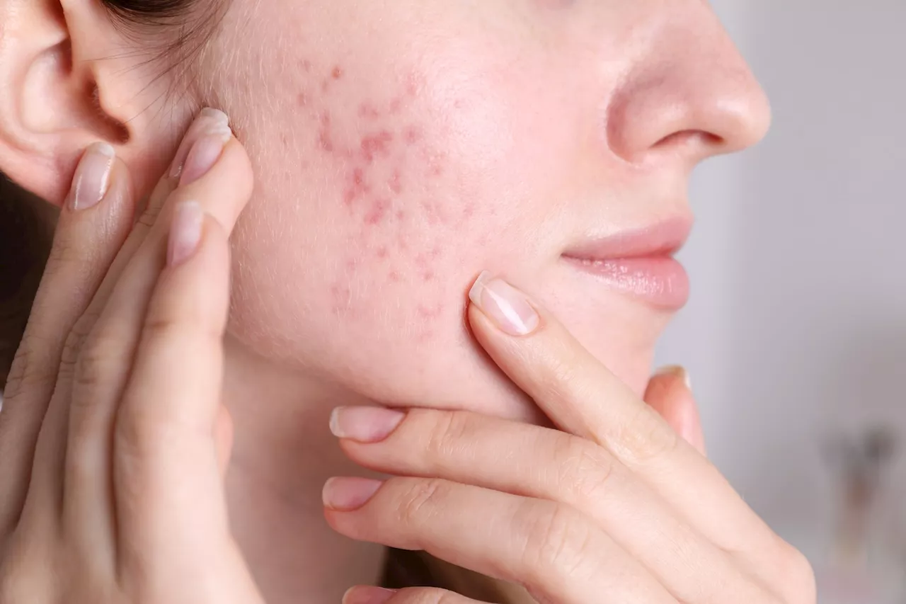 Cumulative Isotretinoin Dosage Linked to Reduced Acne Recurrence