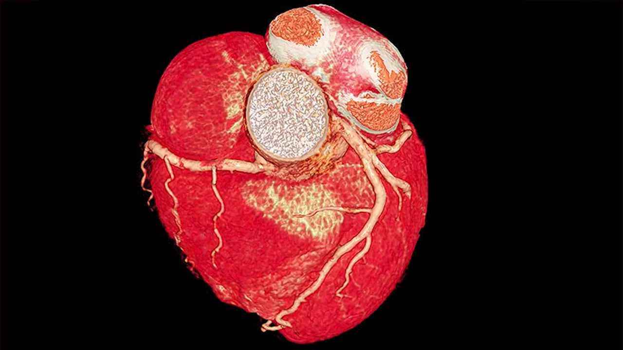 AI Outperforms Human Readers in Assessing Coronary CT Angiography