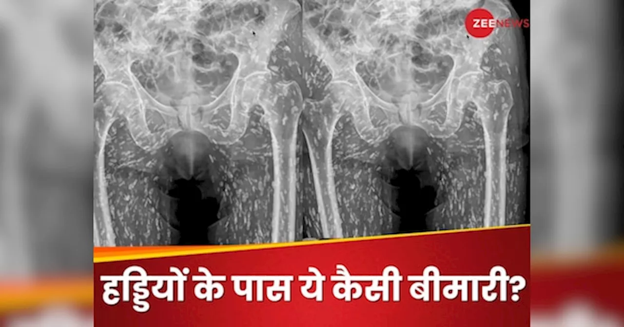 किचन में खाई ऐसी चीज, शुरू हो गया कमरदर्द, X-Ray करवाया तो देखते ही कांप उठे डॉक्टर्स